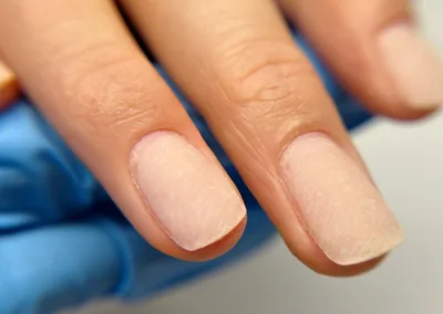 Vorbereitung Naturnagelverstärkung